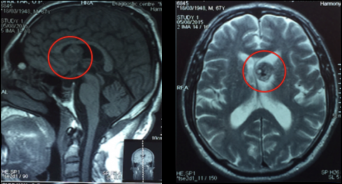 Опухоль головного мозга как выглядит на снимках мрт фото