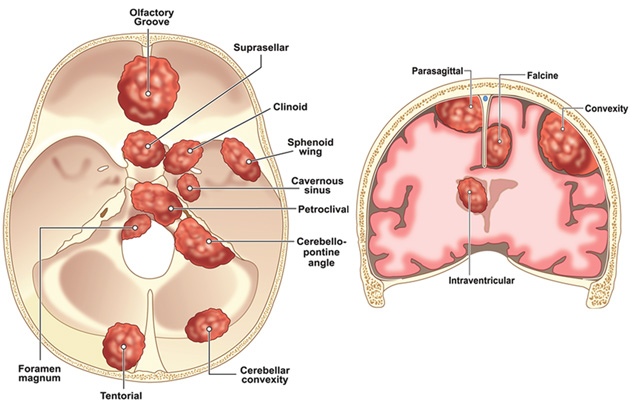 健康・医学 Cranial Meningiomas Meningiomas - Neuroendo