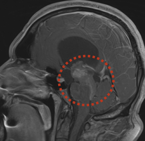 Ventricular tumors, brain stem tumors, colloid cyst of III ventricle ...